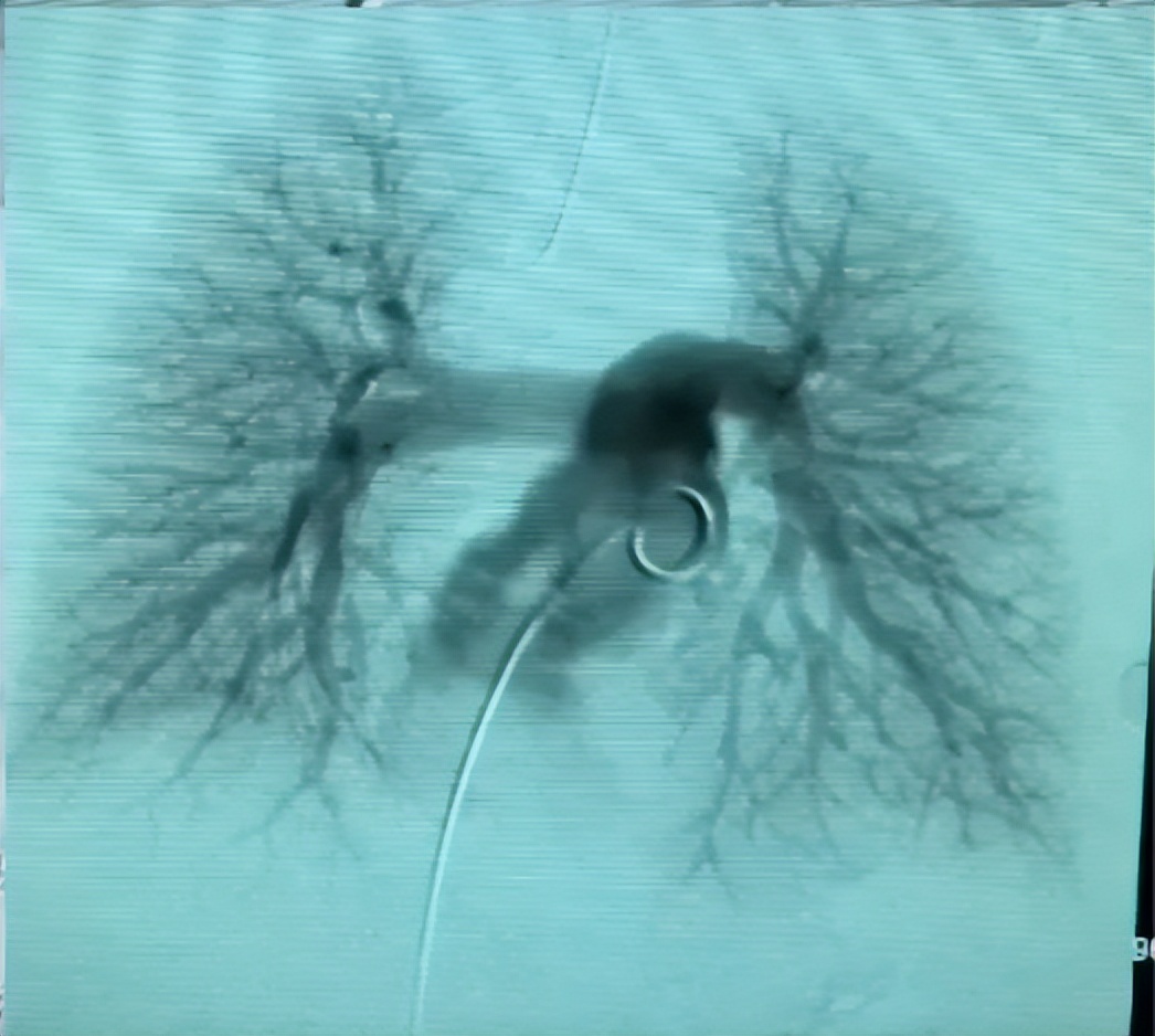 picc拔管遇导管断裂如何处理,picc导管断裂的影像表现