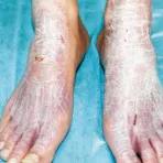 脚底疼是猝死的前兆吗,脚底脱皮是癌症的前兆