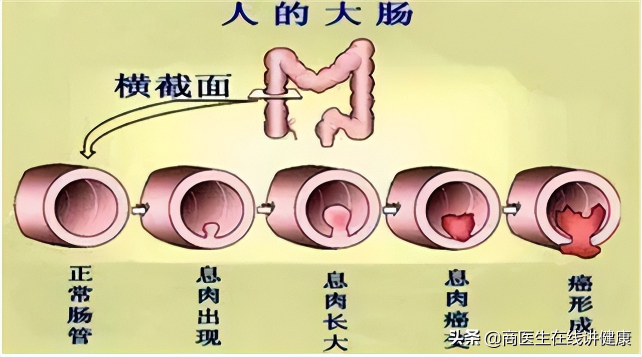 为什么肠道老是长息肉,为什么会有肠道息肉