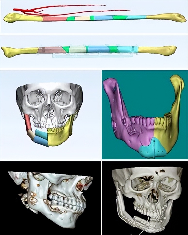 高难度口腔颌面外科手术,口腔颌面外科常见手术