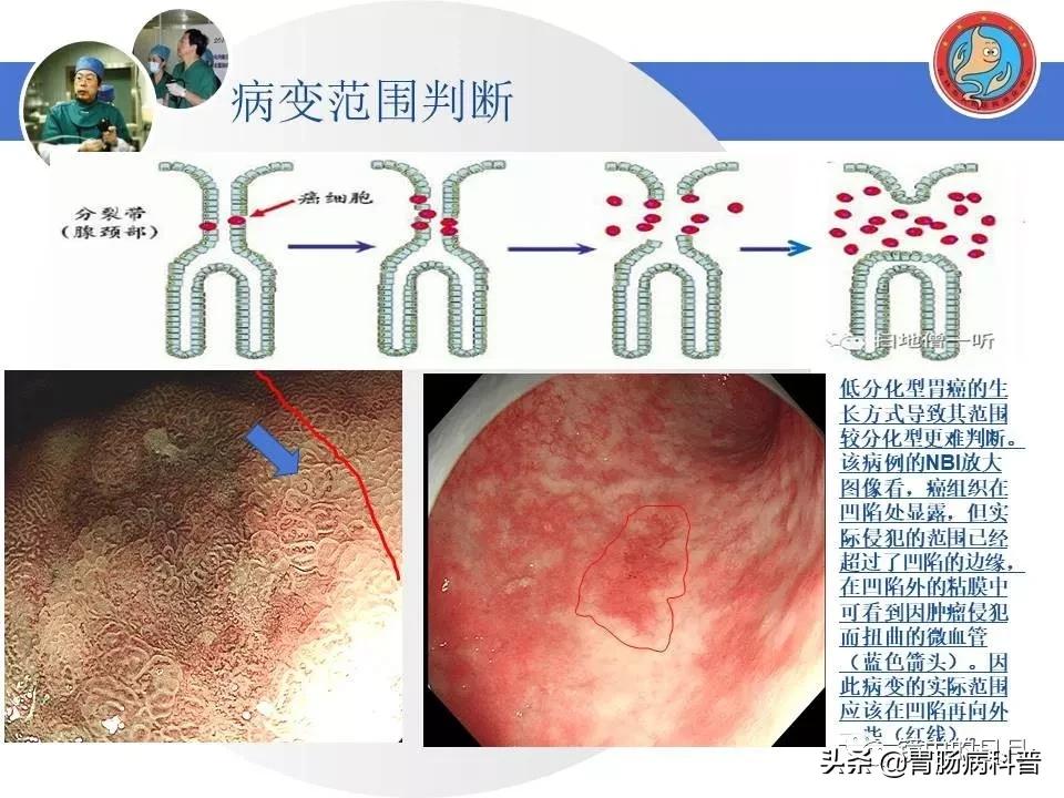 胃癌可以做内镜手术吗,早期胃癌内镜手术后追加外科手术