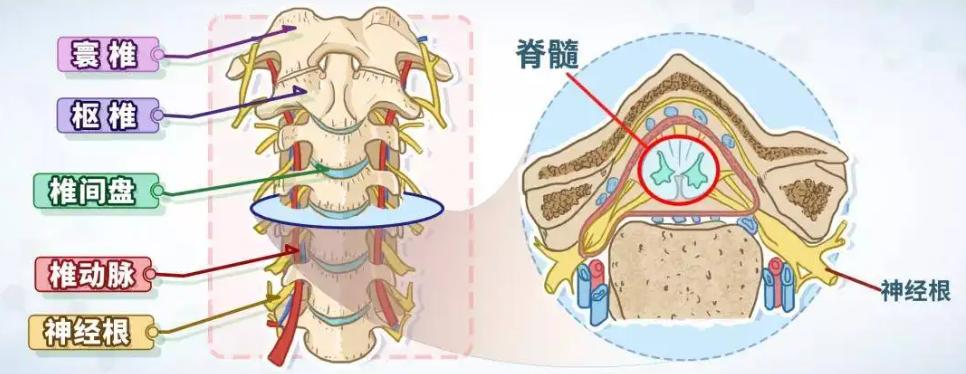 颈椎病导致肩膀胳膊疼得直要命，保守治疗没用，又不能开刀，咋办