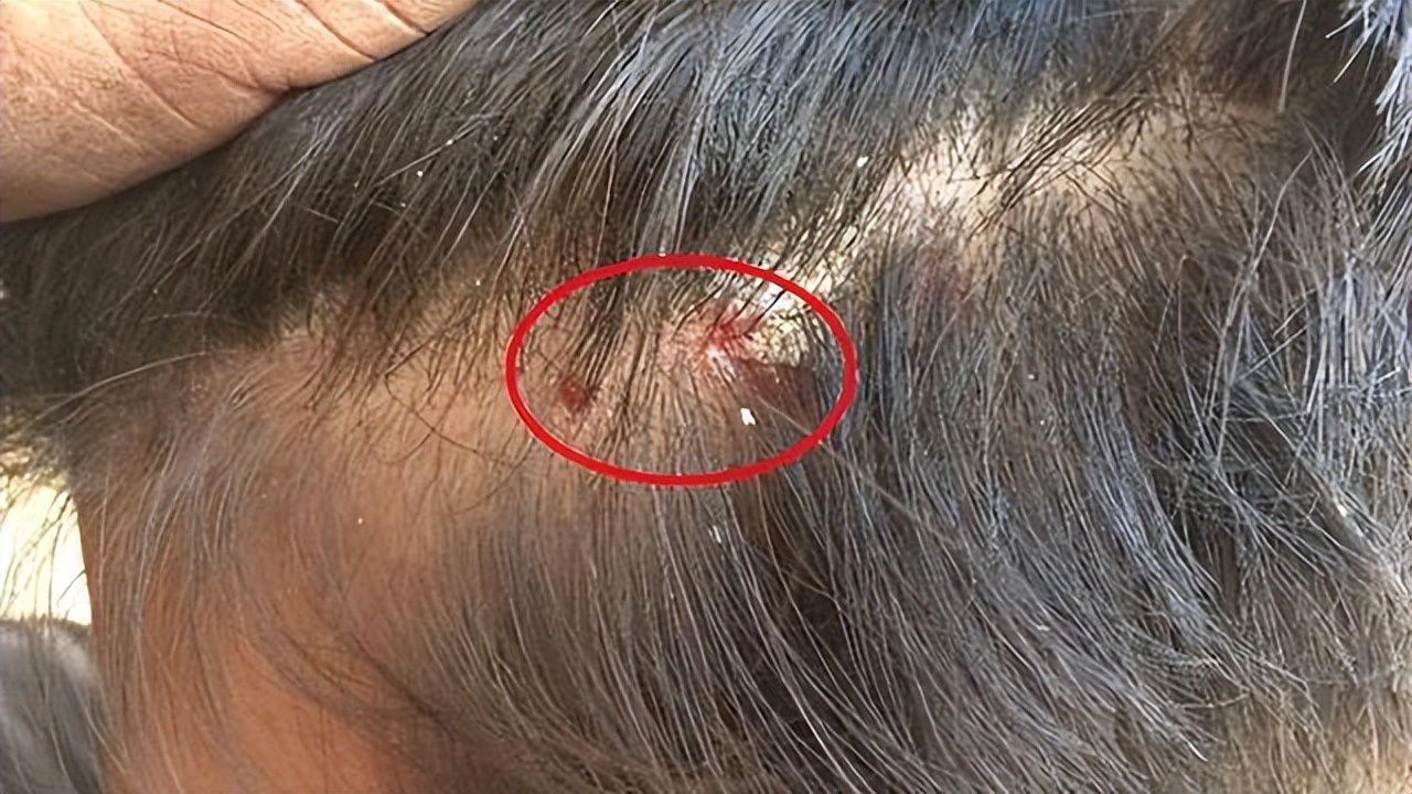 头皮里长的脓包疙瘩是什么原因,头皮上总是长疙瘩和脓包如何根治