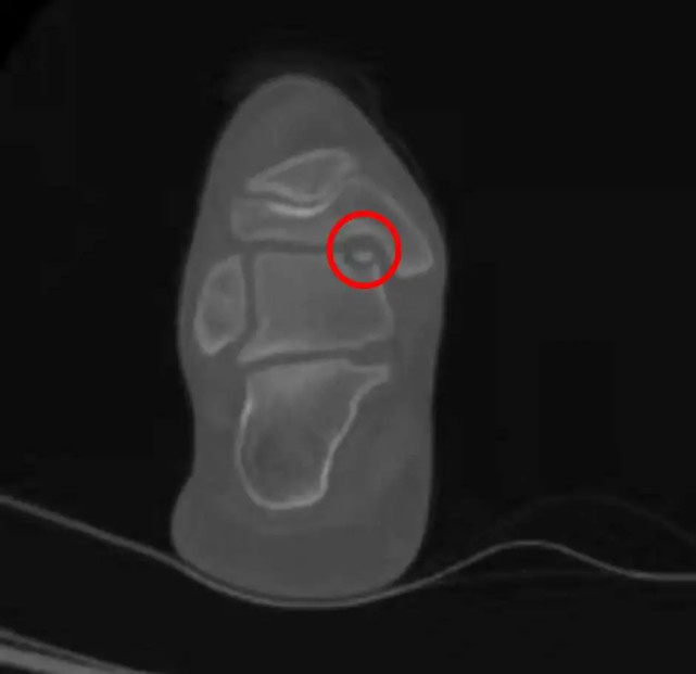 踝关节软骨损伤与踝关节炎区别,踝关节距骨软骨损伤怎么保护的