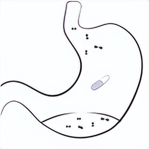溴隐亭回奶注意事项,溴隐亭回奶的用法和用量