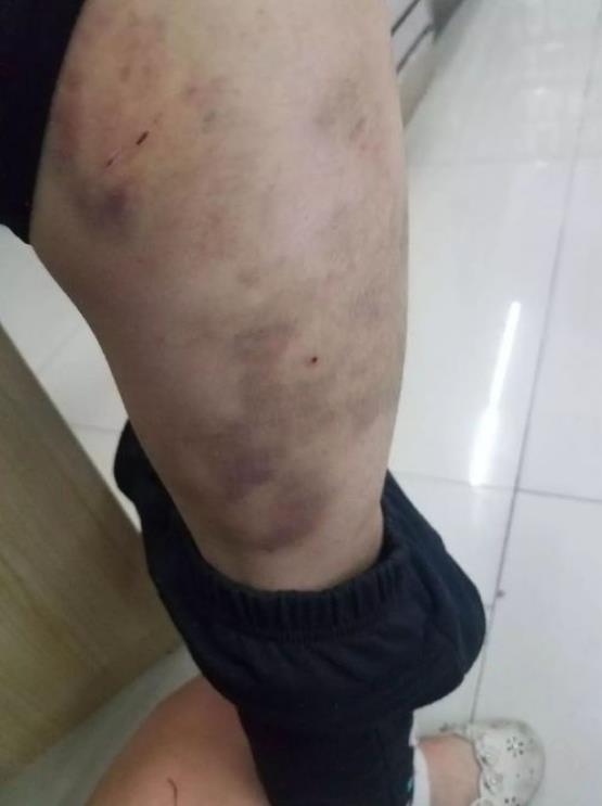 紫癜初期小血点图片,过敏性紫癜中药好还是西药好