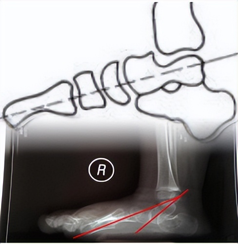 1岁宝宝不愿走路总是要爬怎么办,2岁宝宝一只脚扁平足怎么办