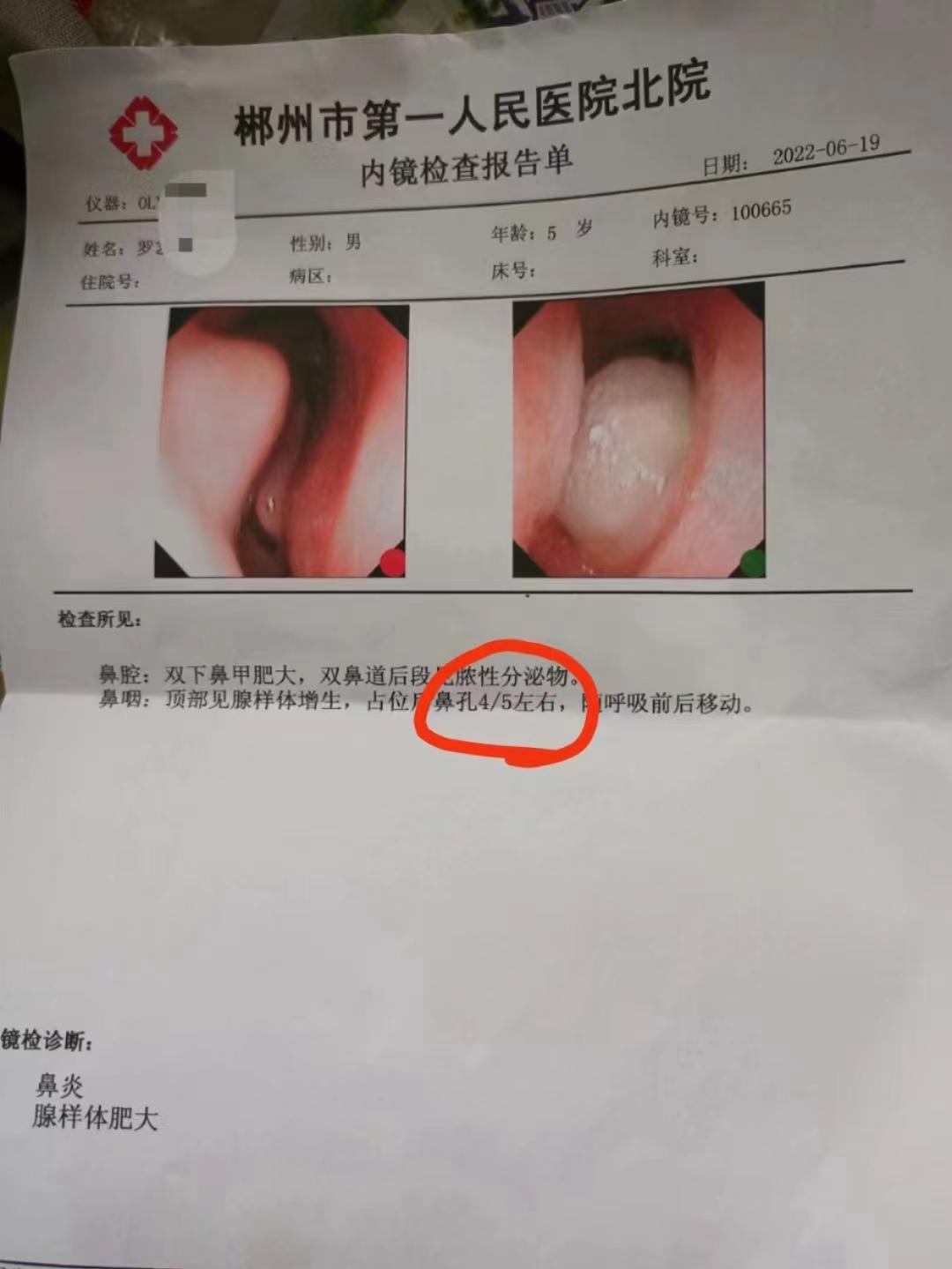 小儿腺样体肥大中医怎么治,中医治疗腺样体肥大的名医