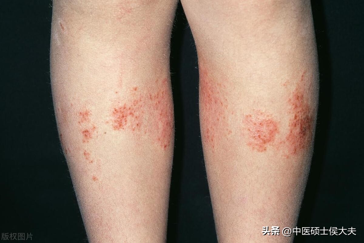 什么中药会引起过敏湿疹荨麻疹,治疗皮肤病麻疹的中草药