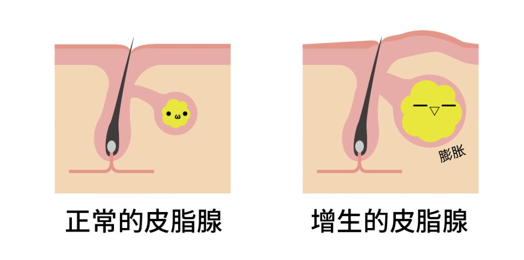 鼻子周围起疙瘩怎么回事,鼻子周围红肿起疙瘩吃什么药
