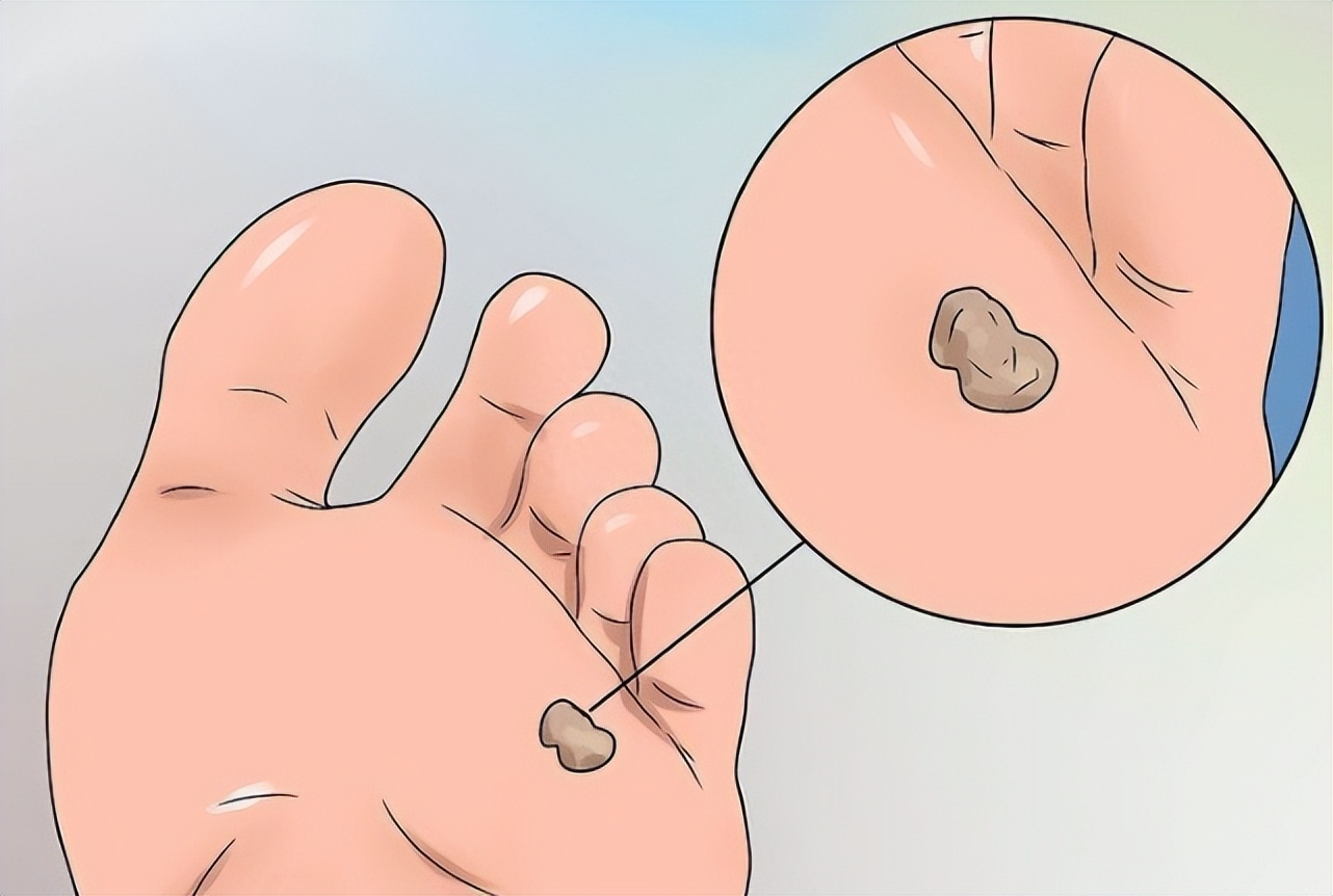 脚上长了类似瘊子又像老茧的东西,长在脚上的鸡眼和疣的区别