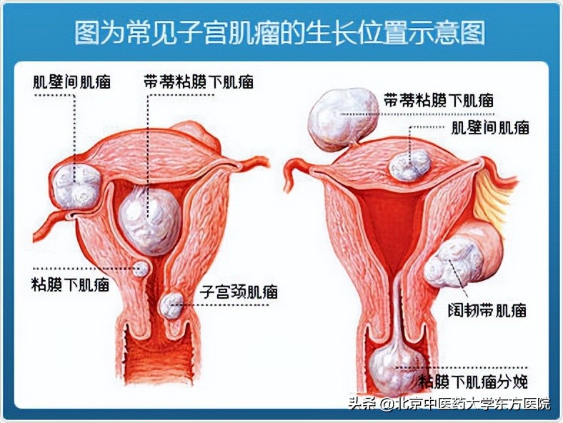 怀孕肚子里为啥长肌瘤,肚子大的像怀孕是不是有肌瘤