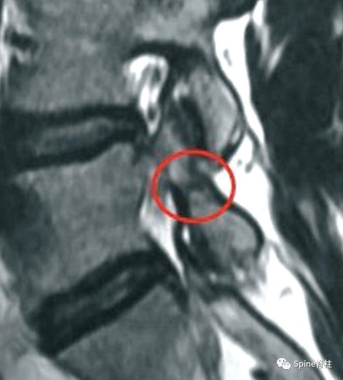 轻度峡部裂和重度峡部裂的区别,真性峡部裂和假性峡部裂