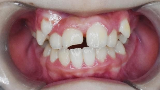 徐州儿童牙齿矫正牙齿不齐,大连口腔医院儿童牙齿矫正怎么样