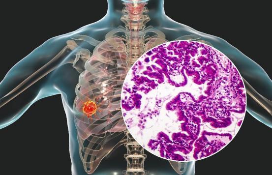 肺磨玻璃结节判断癌症标准是什么,超过15mm的磨玻璃结节都是肺癌吗