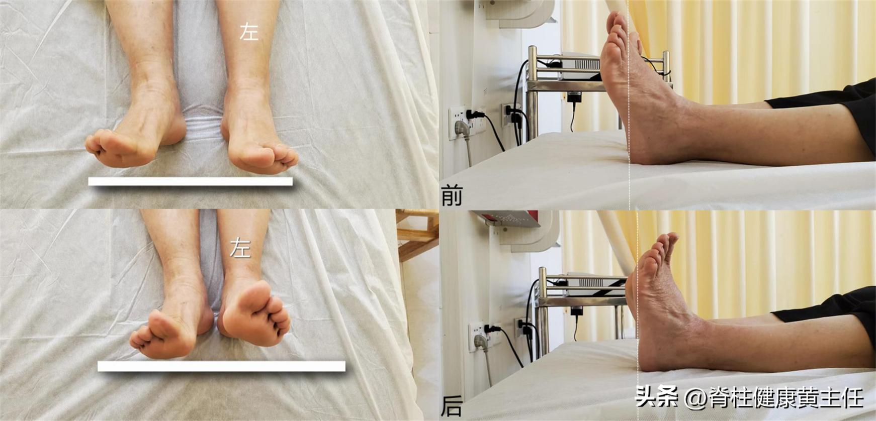 足底疼走路缓解,足底外侧走路疼怎样治疗