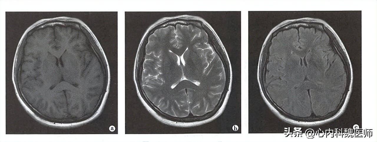 什么叫磁共振检查需要多少时间,磁共振水成像检查需要注意什么