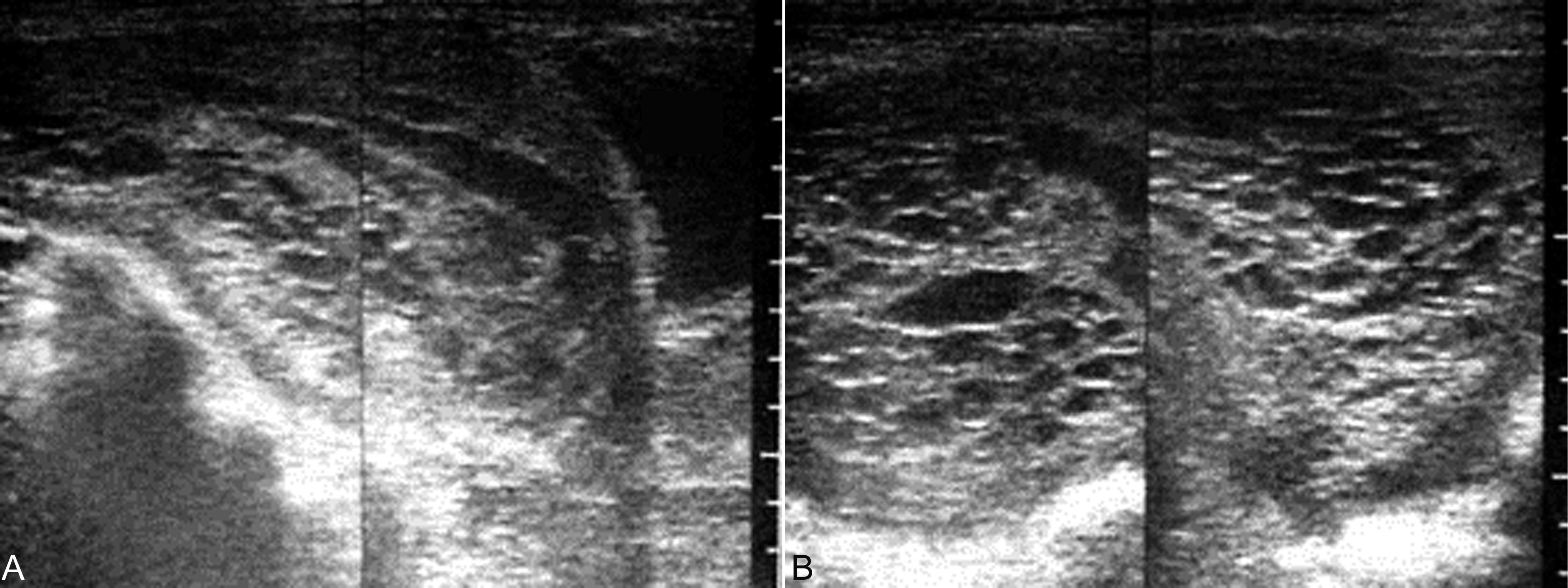 超声全身检查,超声诊断恶性葡萄胎