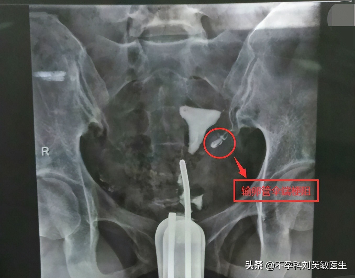 输卵管造影怎么看片子图解,最新的输卵管造影方法