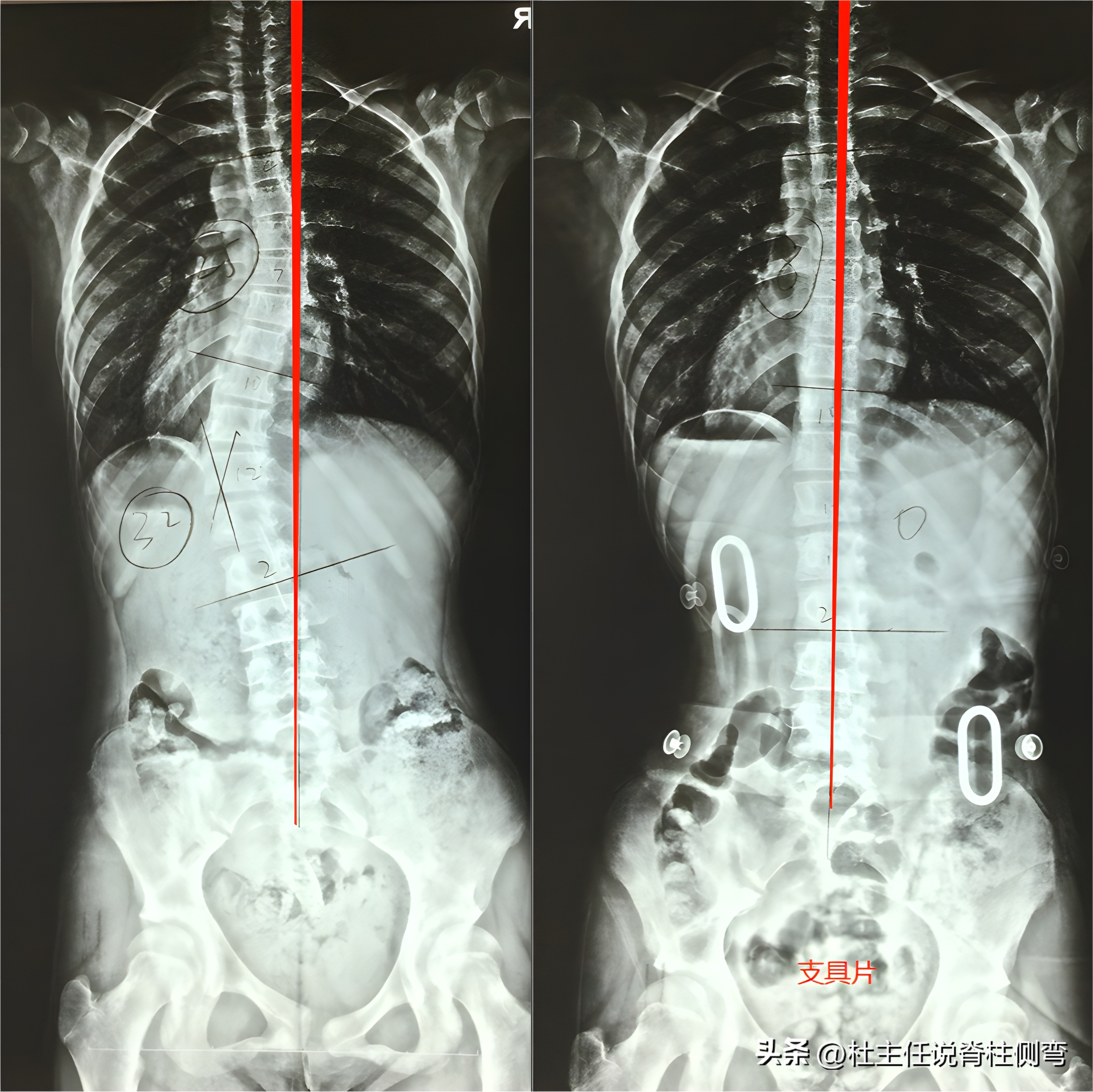 S型脊柱侧弯，一定要戴长支具矫形吗？此文告知您
