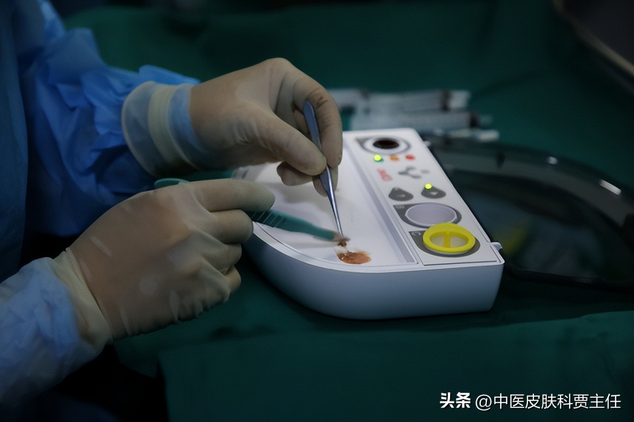 治白癜风的偏方快速治好白癜风,白癜风如何治疗一块大的白斑