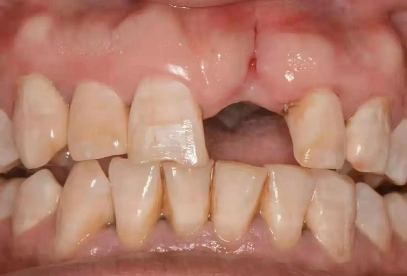 镶牙磨好牙还没镶我后悔了怎么办,已经磨了的牙镶牙还是种植牙好