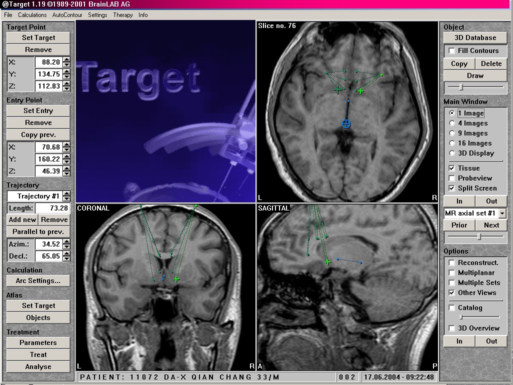 案例视频：18岁少年罹患双相情感障碍手术解除精神折磨