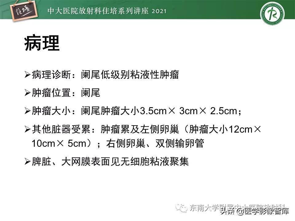 卵巢浆液性肿瘤的肉眼及镜下特征,卵巢原发性粘液性囊腺瘤