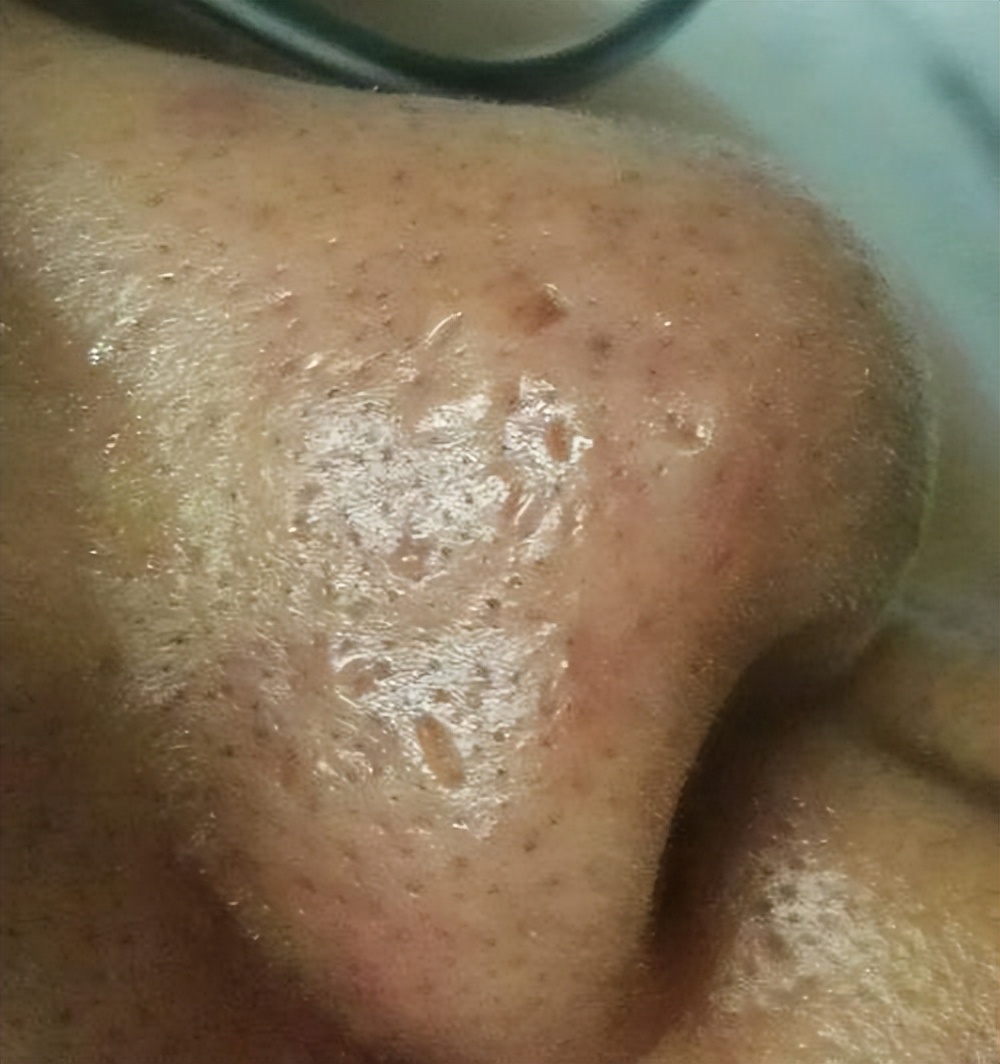 额头眉心发红有闭口粉刺,眉心鼻头频繁起粉刺怎么办