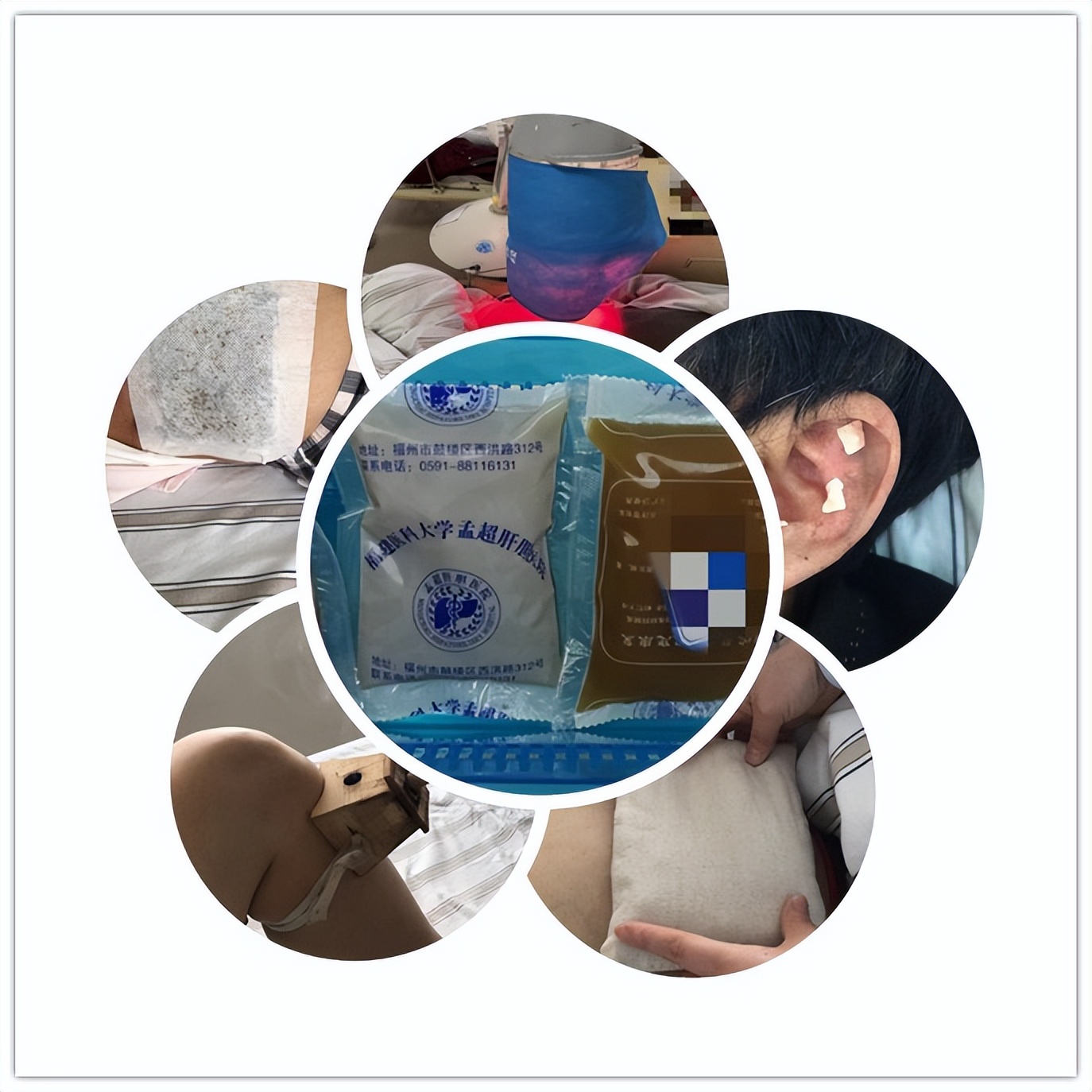 黄疸和肝衰竭有什么关系,肝衰竭黄疸人工肝后反弹