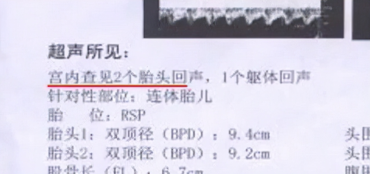 中国首例双头婴儿现状如何,全国首例双头婴儿现在咋样了