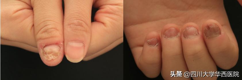 华西专家说，不是转你们，起码有一半的人从没有剪对过指甲儿！