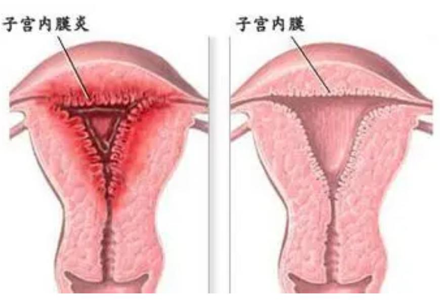 *处私**不规律出血原因很多，最坏的可能会是宫颈癌