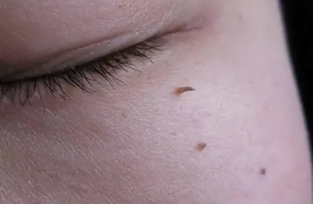 与你说说颈部小肉球的那些事,抠掉会怎样?如何处理?一文看懂