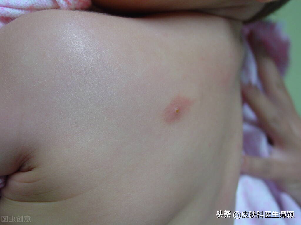 皮肤科医生和你聊聊：初夏季节，如何防治“丘疹性*麻疹荨**”？