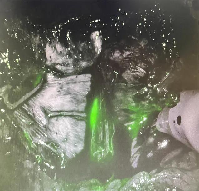 介入治疗前列腺增生效果怎么样,超微创手术治疗前列腺增生