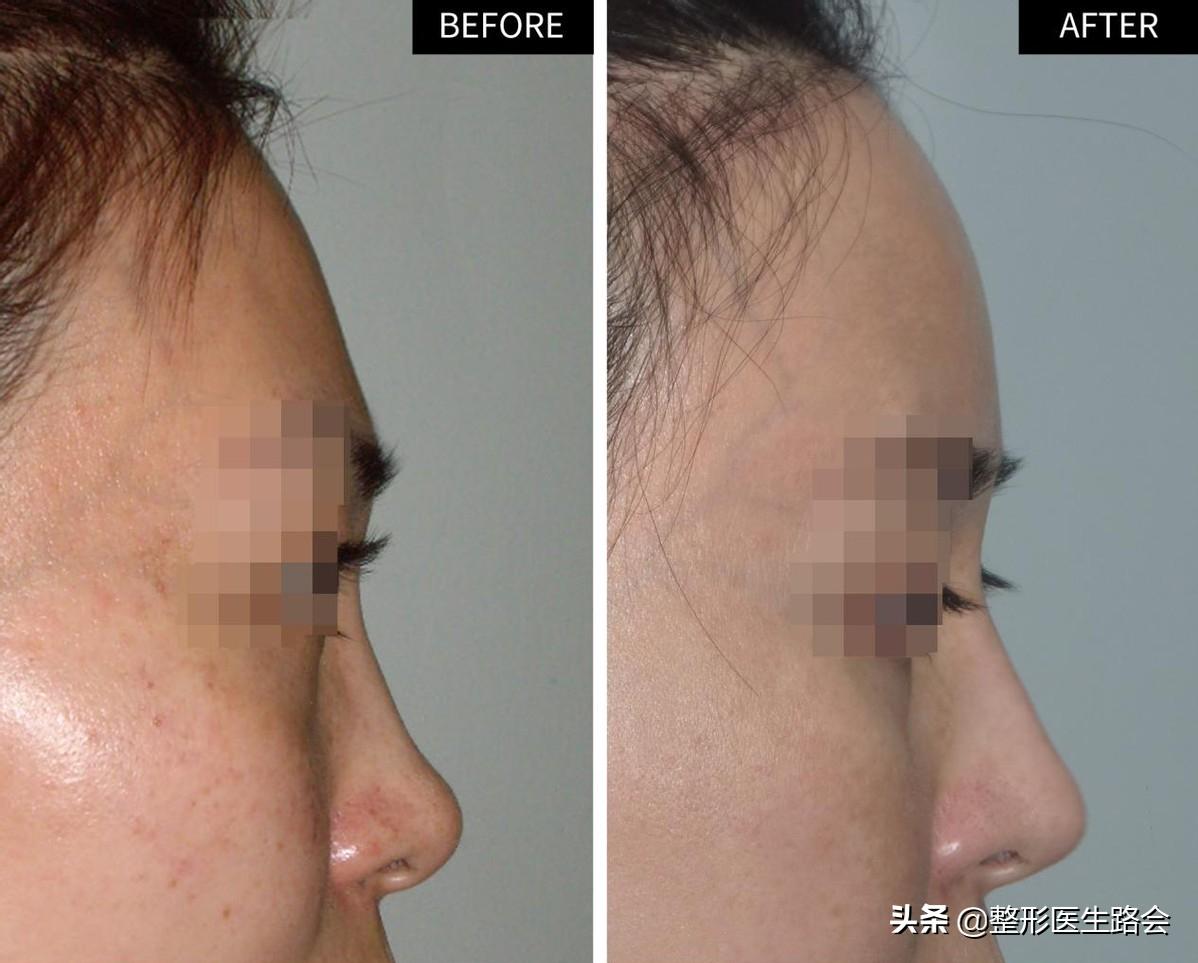 填充额头出现凹坑过于饱满,额头填充怎么避免踩坑