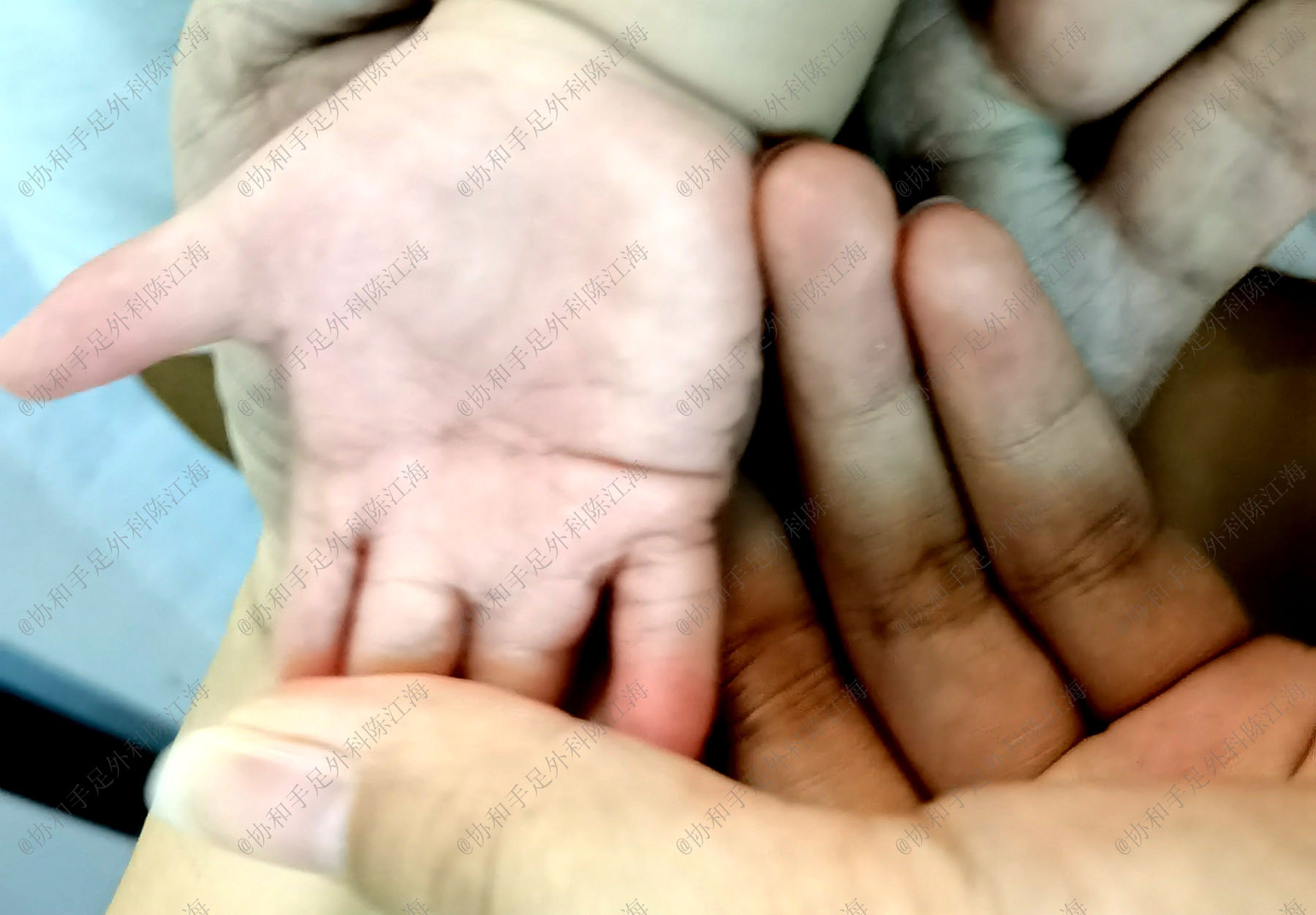 儿童做了植皮长大还需要植皮吗,小孩植皮后长大后还需要植皮吗