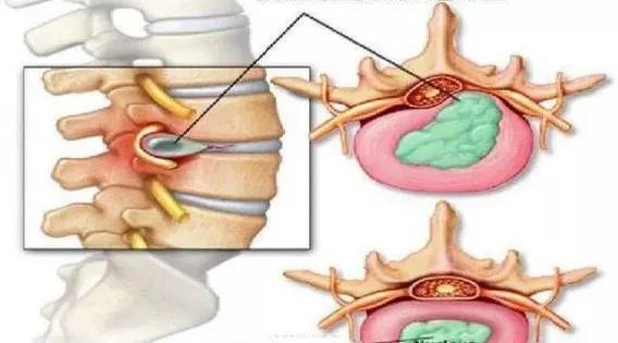 腰椎间盘突出微创术,中央型腰椎间盘突出
