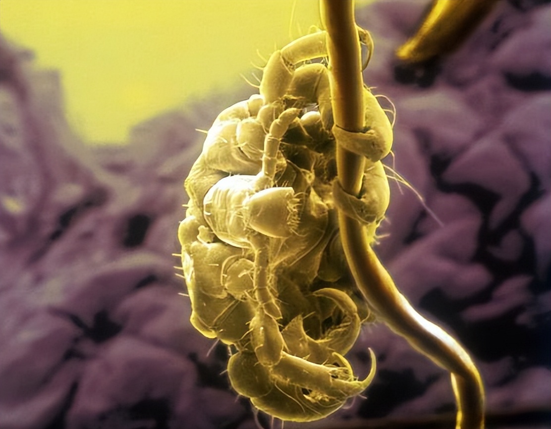 女子体内有蜱虫被医生拿镊子拔出,女子身上长虫医生拿镊子治疗