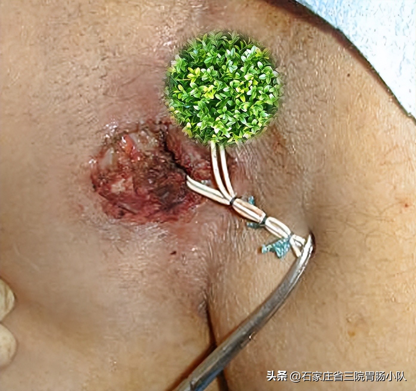 肛周脓肿中医说法怎么引起的,肛周脓肿经历描述