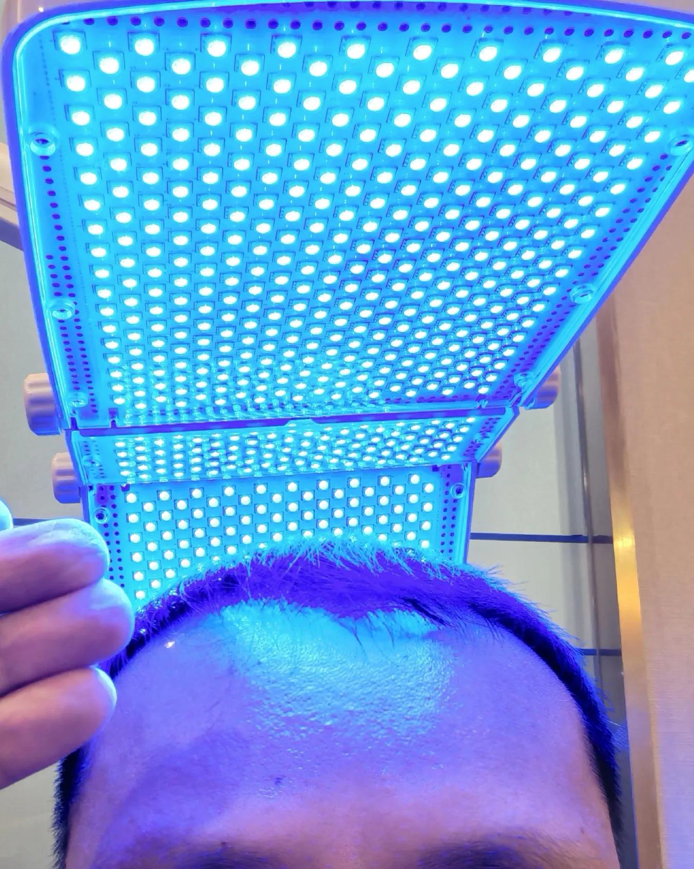 雄脱植发的亲身经历和感受,16000字讲述植发真实感受