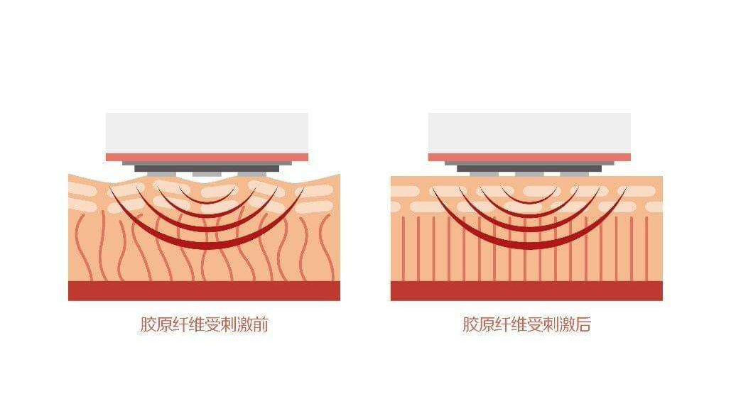 家用美容仪哪个效果最好,家用美容仪视频教程