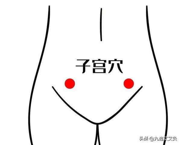 子宫腺肌症艾灸哪个穴位最好,做艾灸能改善子宫动脉阻力么