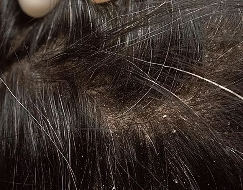 一抓头皮指甲里就有白泥怎么办,头皮一抓指甲里都是白泥