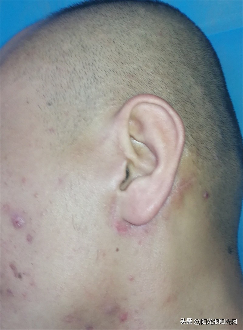 左侧腮腺肿瘤恶化,颈部腮腺疯狂长肿瘤