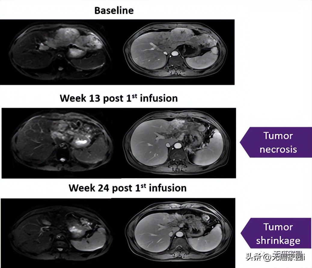 tcr-t疗法临床试验招募,国内首例crt疗法