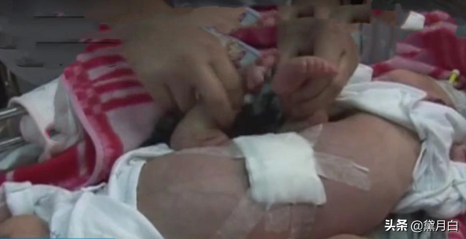 湖北夫妻生下连体婴儿,女子怀孕生下双头怪婴