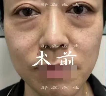 北京做眼袋手术大概需要多少钱,到正规大医院做眼袋手术有风险吗