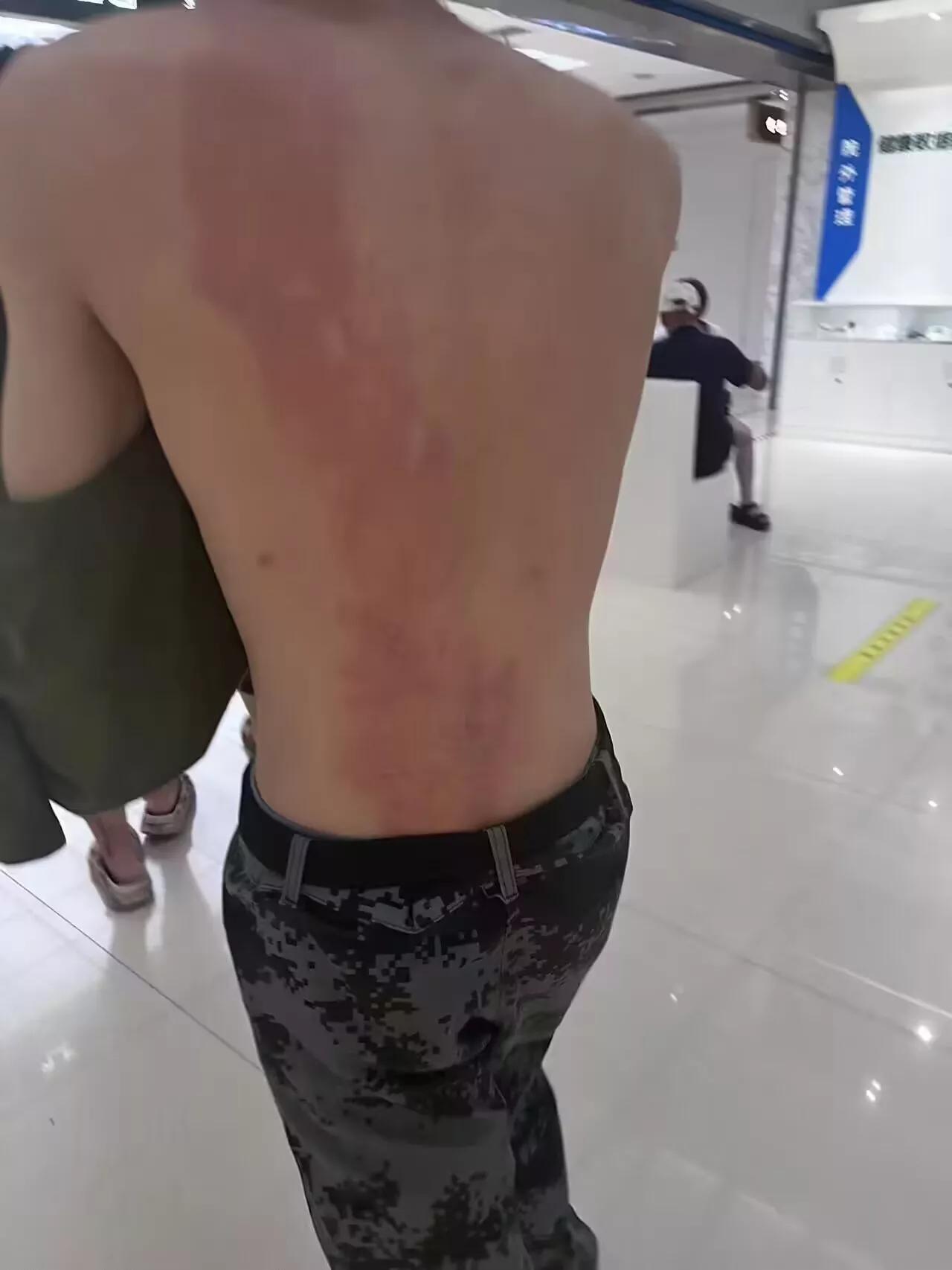 一个男生,把女生的朋友圈转发了,遭到报复,被喷漆加热水烫伤。